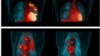 Medical Imaging May Help Find New TB Drugs